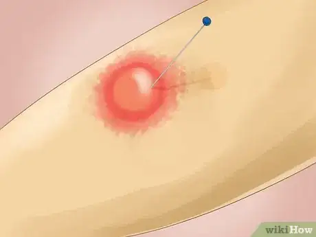 Image intitulée Relieve Blister Pain Step 10