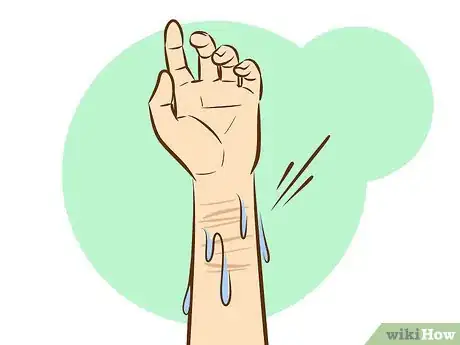 Image intitulée Get Rid of Self Harm Scars Step 15