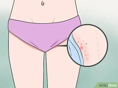 Image intitulée Recognize Vulva Cancer Symptoms Step 1