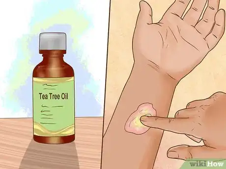 Image intitulée Treat Fungal Rash Step 3