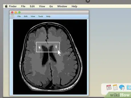Image intitulée Read an MRI Step 13