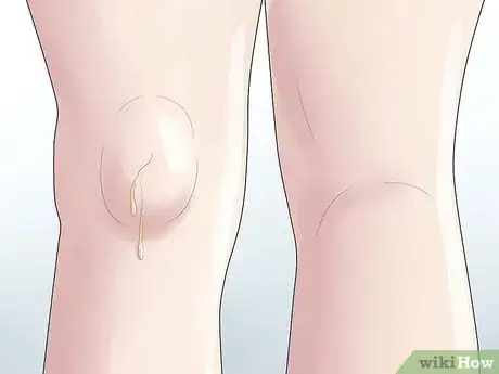 Image intitulée Know if You Have a Baker's Cyst Step 6