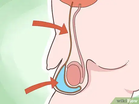 Image intitulée Know if You Have Hydrocele Step 12