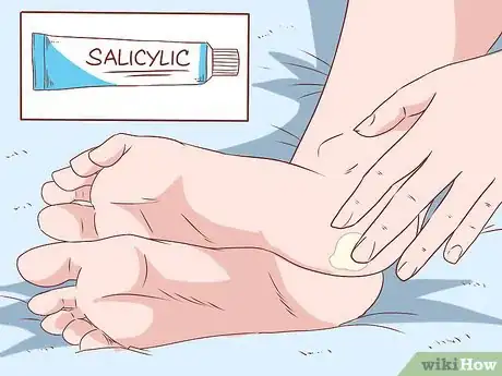 Image intitulée Get Rid of Calluses on Feet Step 5