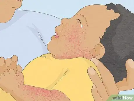 Image intitulée Treat Baby Heat Rash Step 9