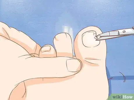 Image intitulée Help a Toenail Grow Back Quickly Step 1