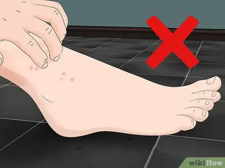 Image intitulée Treat Sand Flea Bites Step 1