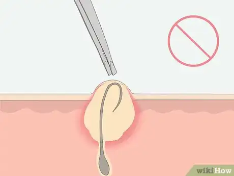 Image intitulée Get Rid of Ingrown Pubic Hair Step 17