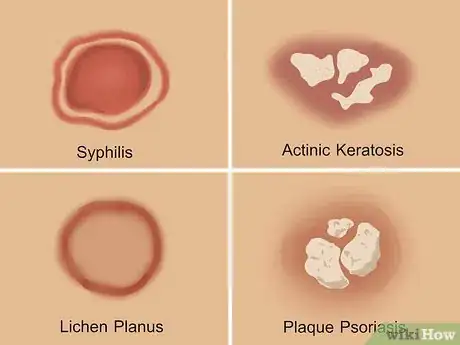 Image intitulée Diagnose Discoid Lupus Step 2