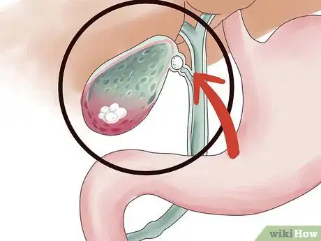 Image intitulée Know if You Have Cirrhosis Step 15