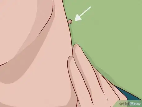 Image intitulée Remove a Skin Tag from Your Neck Step 5