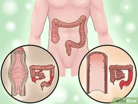 Image intitulée Distinguish Ulcerative Colitis from Similar Conditions Step 7