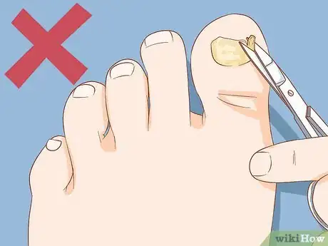 Image intitulée Help a Toenail Grow Back Quickly Step 9