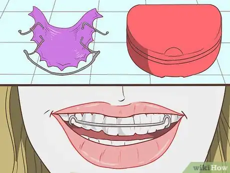 Image intitulée Straighten Your Teeth Without Braces Step 14