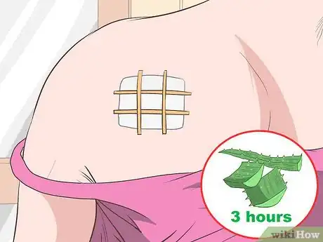 Image intitulée Remove Moles Without Surgery Step 12