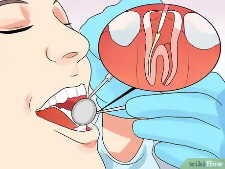 Image intitulée Stop Root Canal Pain Step 16