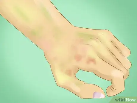 Image intitulée Diagnose Unusually Cold Hands Step 8