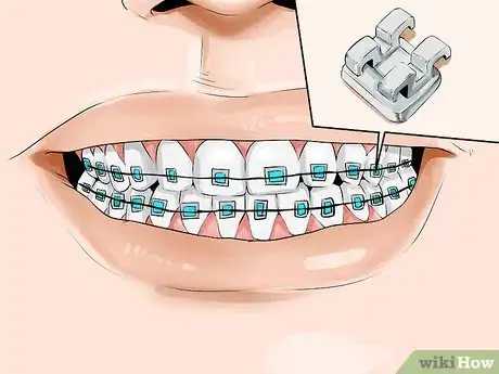 Image intitulée Connect a Rubber Band to Your Braces Step 2