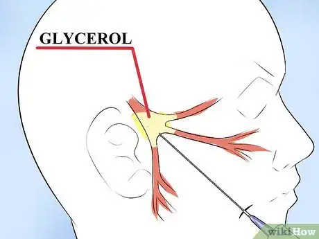 Image intitulée Alleviate Pain Caused by Trigeminal Neuralgia Step 9