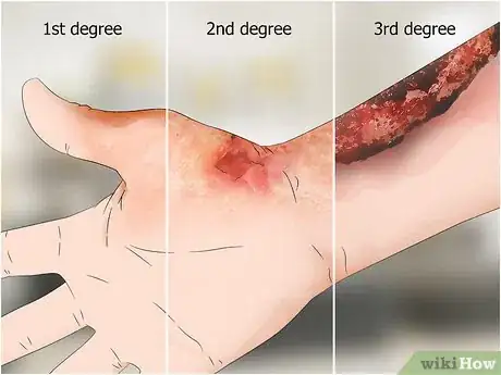 Image intitulée Heal Burns Fast Step 1