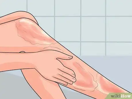 Image intitulée Treat a Hot Water Spill on Your Skin Step 5