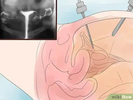 Image intitulée Treat Blocked Fallopian Tubes Step 5