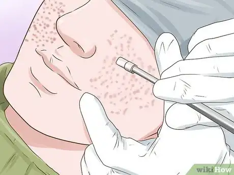 Image intitulée Erase a Pimple Scar Step 10