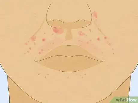 Image intitulée Treat a Face Rash After Waxing Step 1