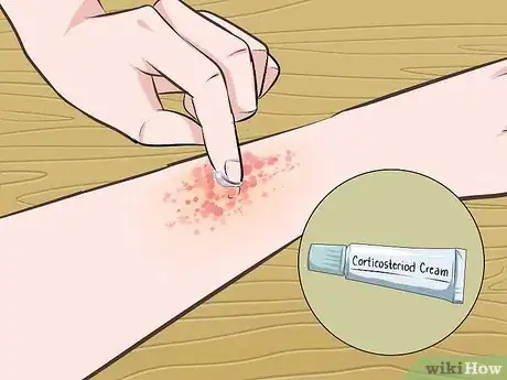 Image intitulée Get Rid of Poison Oak Rash Step 12