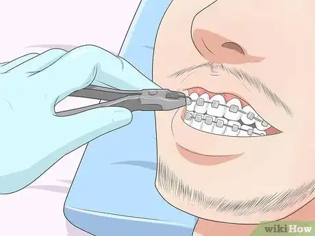 Image intitulée Make Your Braces Hurt Less Step 12