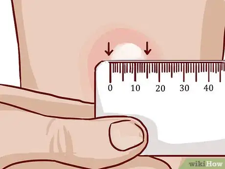 Image intitulée Read a Tuberculosis Skin Test Step 7