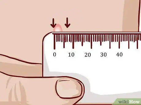 Image intitulée Read a Tuberculosis Skin Test Step 9