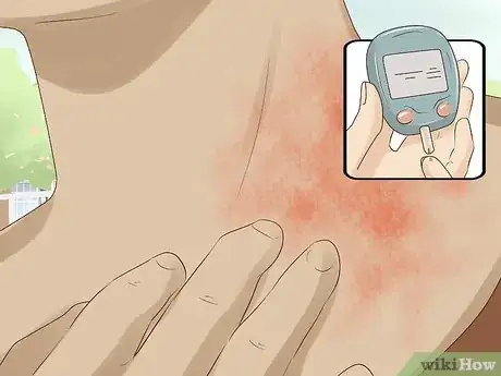 Image intitulée Treat a Yeast Infection on Your Skin Step 5.jpeg