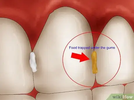 Image intitulée Get Rid of Gingivitis Step 2