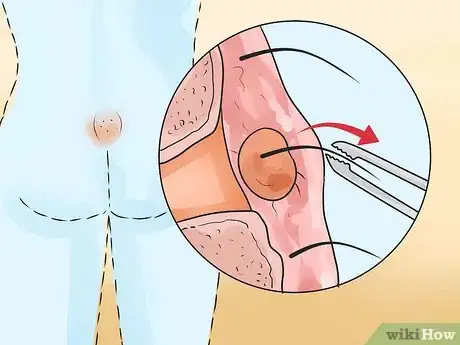 Image intitulée Get Rid of a Cyst Step 12