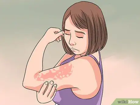 Image intitulée Decrease Eczema Flare Ups Step 1