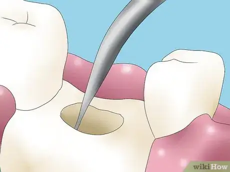 Image intitulée Reverse Dental Bone Loss Step 5