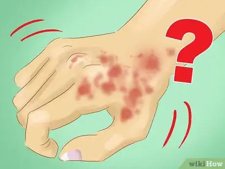 Image intitulée Diagnose Unusually Cold Hands Step 9