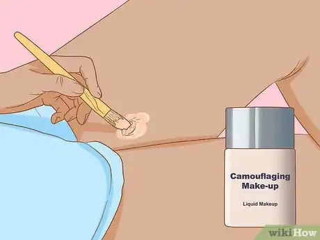 Image intitulée Get Rid of Boil Scars Step 11