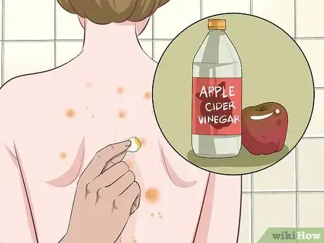 Image intitulée Get Rid of Back Acne Fast Step 8