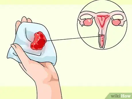 Image intitulée Recognize Cervical Cancer Symptoms Step 2