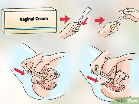 Image intitulée Treat Vaginitis Step 9