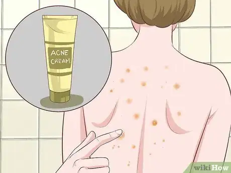 Image intitulée Get Rid of Back Acne Fast Step 3