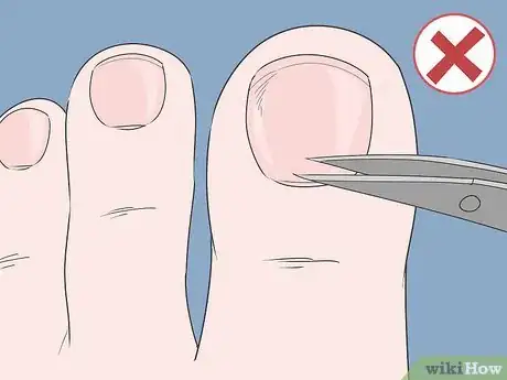 Image intitulée Treat a Hangnail Infection Step 16