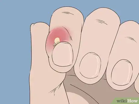 Image intitulée Treat a Hangnail Infection Step 10