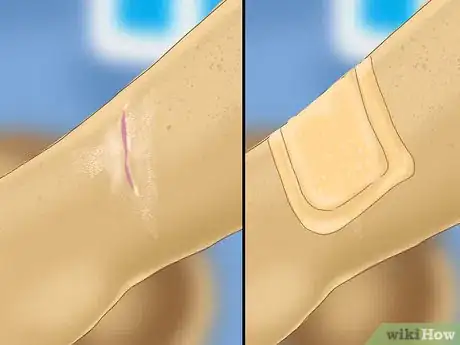 Image intitulée Heal a Cut Due to Dry Skin Step 4