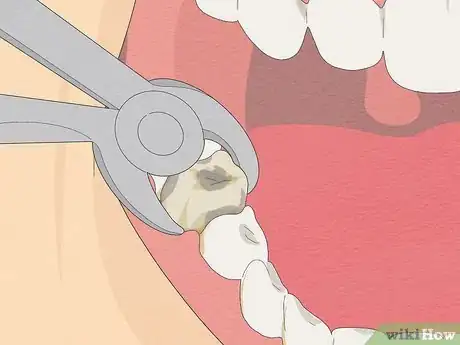 Image intitulée Fix Rotting Teeth Step 6