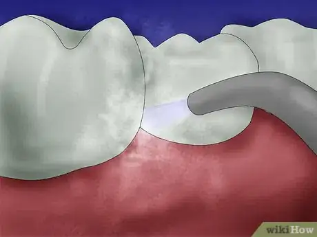 Image intitulée Get Rid of Gingivitis Step 6