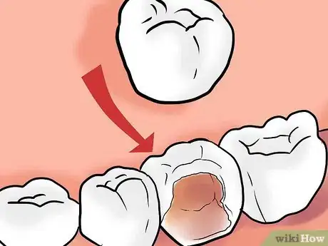 Image intitulée Get Rid of Tooth Pain Step 17