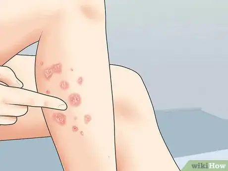 Image intitulée Diagnose Psoriasis Step 2